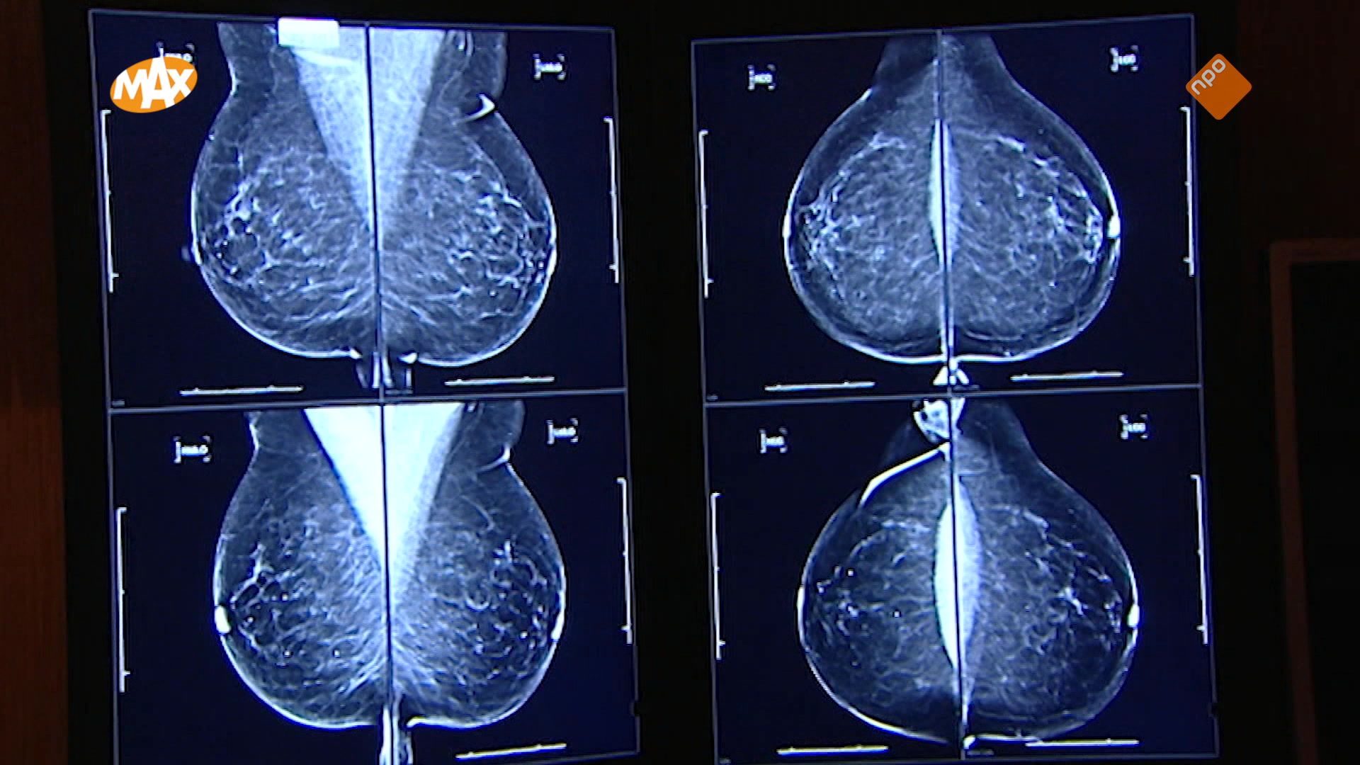 Strijd met ziekenhuis na gemiste diagnose